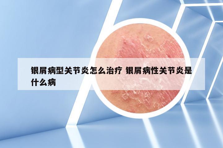 银屑病型关节炎怎么治疗 银屑病性关节炎是什么病