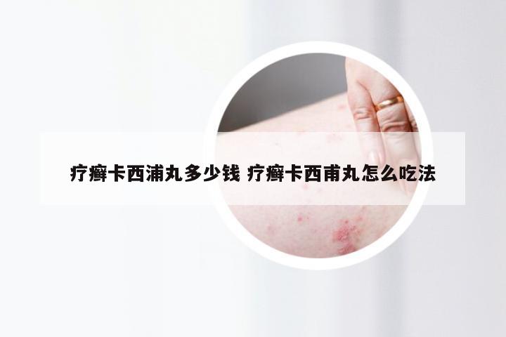 疗癣卡西浦丸多少钱 疗癣卡西甫丸怎么吃法