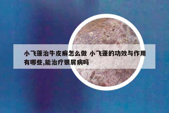 小飞蓬治牛皮癣怎么做 小飞蓬的功效与作用有哪些,能治疗银屑病吗