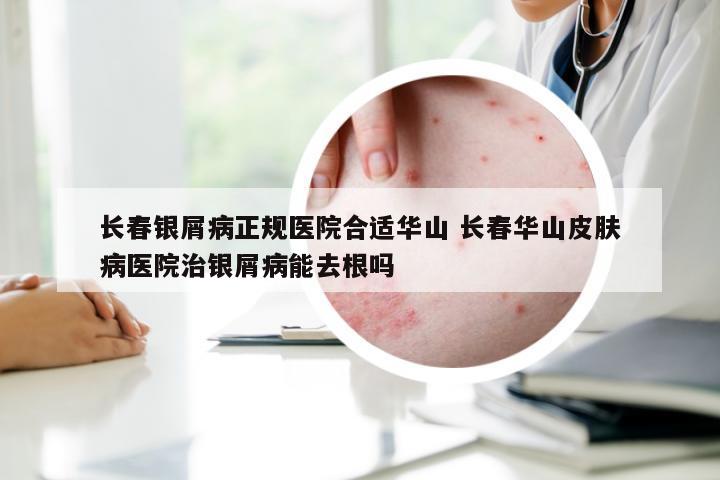 长春银屑病正规医院合适华山 长春华山皮肤病医院治银屑病能去根吗