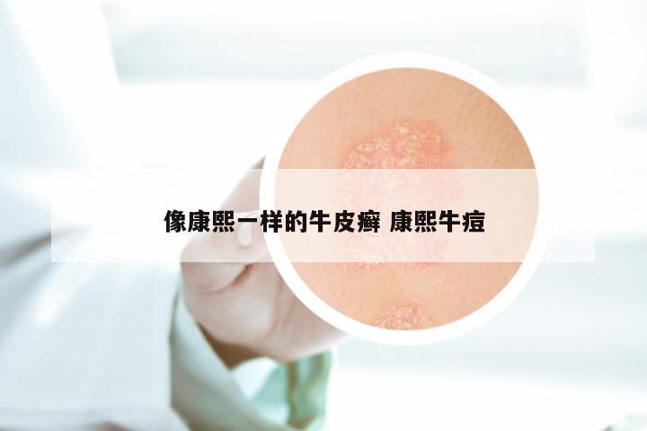 像康熙一样的牛皮癣 康熙牛痘
