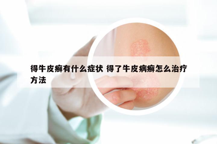 得牛皮癣有什么症状 得了牛皮病癣怎么治疗方法