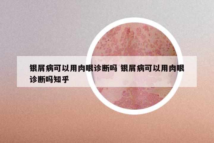 银屑病可以用肉眼诊断吗 银屑病可以用肉眼诊断吗知乎
