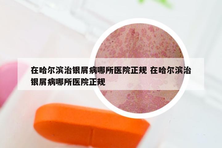 在哈尔滨治银屑病哪所医院正规 在哈尔滨治银屑病哪所医院正规