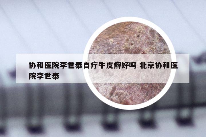 协和医院李世泰自疗牛皮癣好吗 北京协和医院李世泰