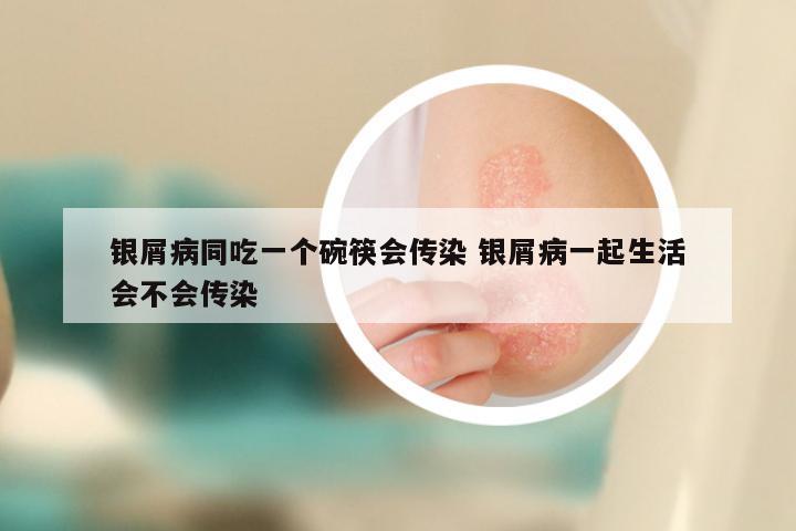 银屑病同吃一个碗筷会传染 银屑病一起生活会不会传染