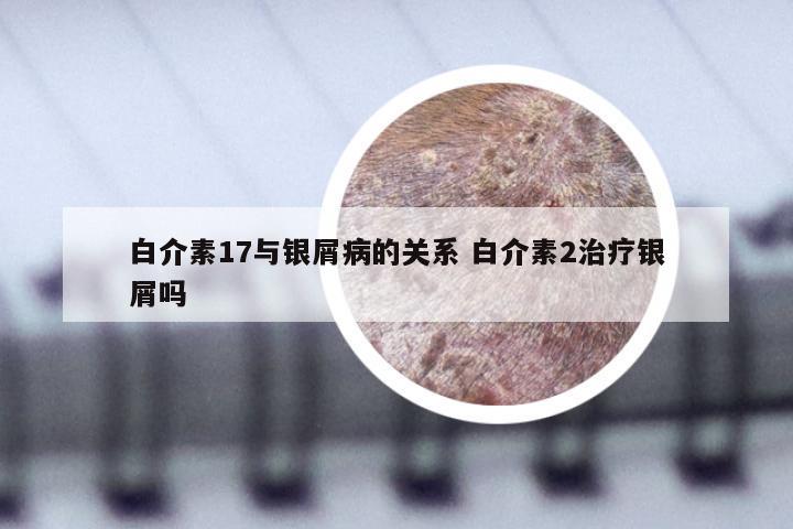 白介素17与银屑病的关系 白介素2治疗银屑吗
