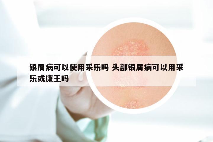 银屑病可以使用采乐吗 头部银屑病可以用采乐或康王吗