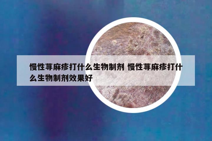 慢性荨麻疹打什么生物制剂 慢性荨麻疹打什么生物制剂效果好