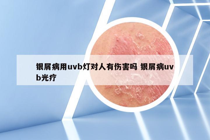 银屑病用uvb灯对人有伤害吗 银屑病uvb光疗
