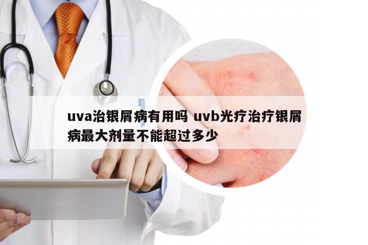 uva治银屑病有用吗 uvb光疗治疗银屑病最大剂量不能超过多少