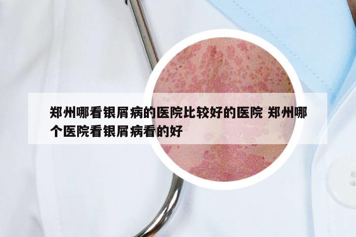 郑州哪看银屑病的医院比较好的医院 郑州哪个医院看银屑病看的好