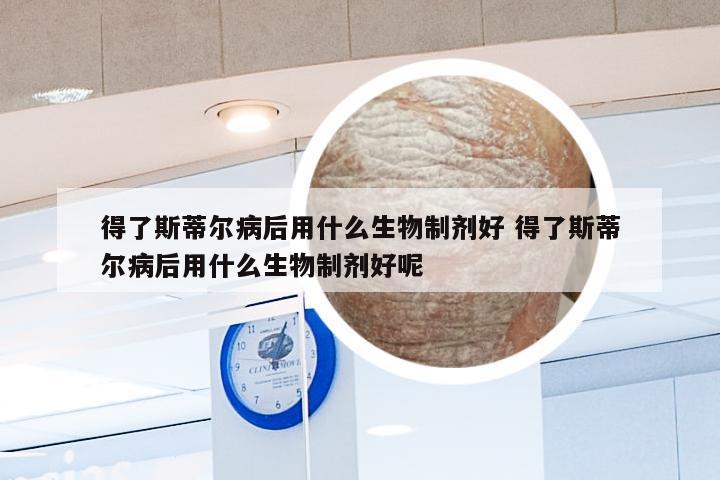 得了斯蒂尔病后用什么生物制剂好 得了斯蒂尔病后用什么生物制剂好呢