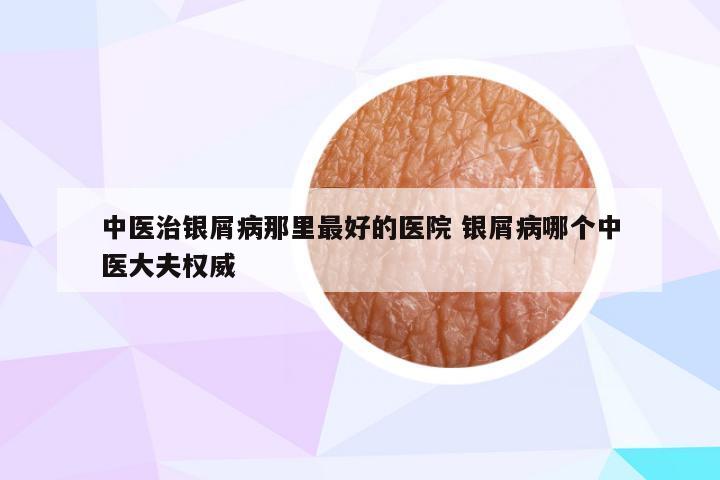 中医治银屑病那里最好的医院 银屑病哪个中医大夫权威