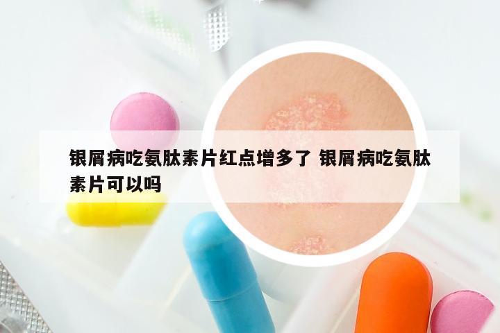 银屑病吃氨肽素片红点增多了 银屑病吃氨肽素片可以吗