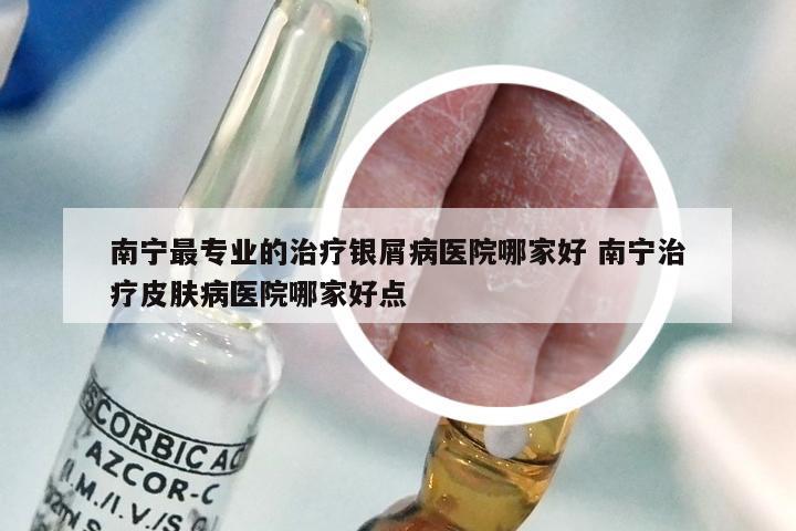 南宁最专业的治疗银屑病医院哪家好 南宁治疗皮肤病医院哪家好点
