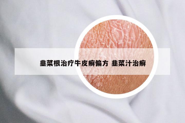韭菜根治疗牛皮癣偏方 韭菜汁治癣