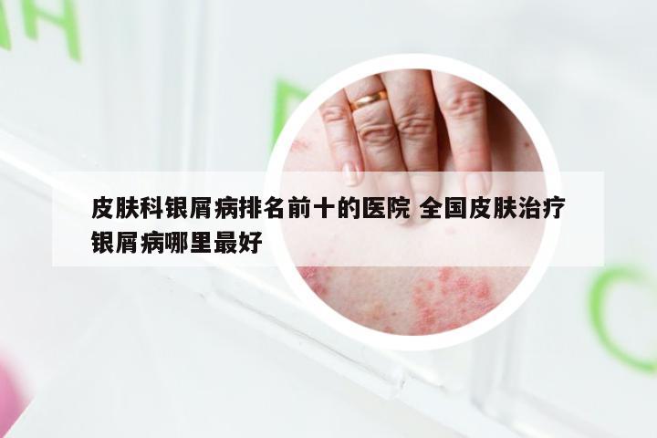 皮肤科银屑病排名前十的医院 全国皮肤治疗银屑病哪里最好