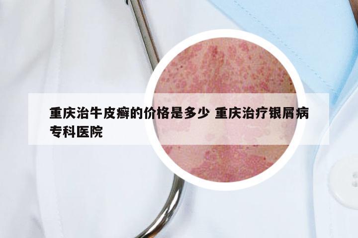 重庆治牛皮癣的价格是多少 重庆治疗银屑病专科医院