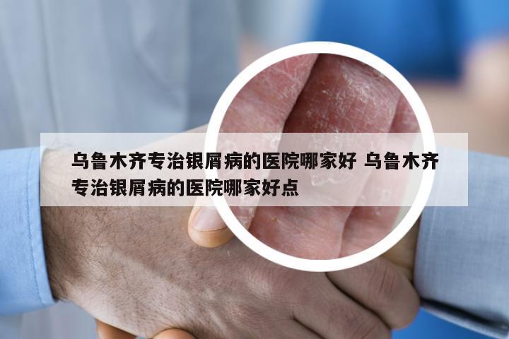 乌鲁木齐专治银屑病的医院哪家好 乌鲁木齐专治银屑病的医院哪家好点