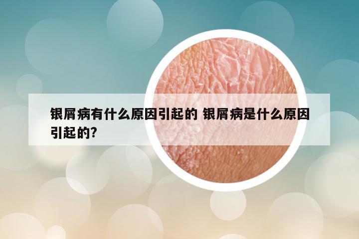银屑病有什么原因引起的 银屑病是什么原因引起的?