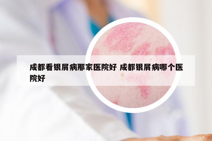 成都看银屑病那家医院好 成都银屑病哪个医院好