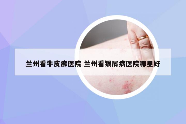 兰州看牛皮癣医院 兰州看银屑病医院哪里好
