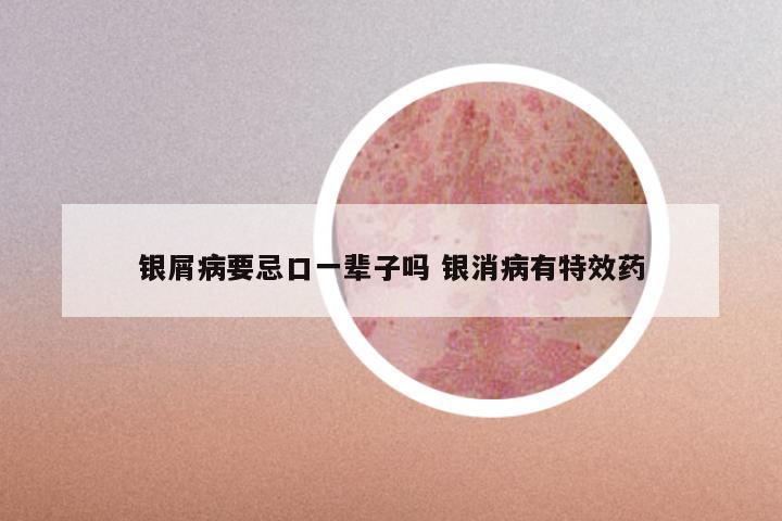 银屑病要忌口一辈子吗 银消病有特效药