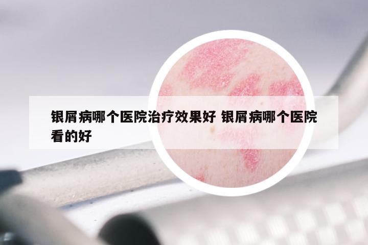 银屑病哪个医院治疗效果好 银屑病哪个医院看的好