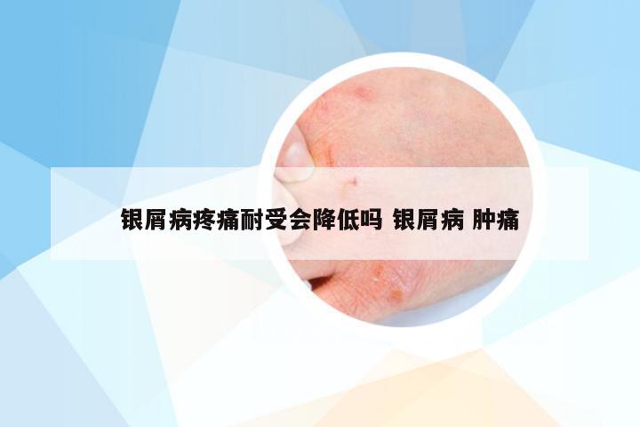 银屑病疼痛耐受会降低吗 银屑病 肿痛