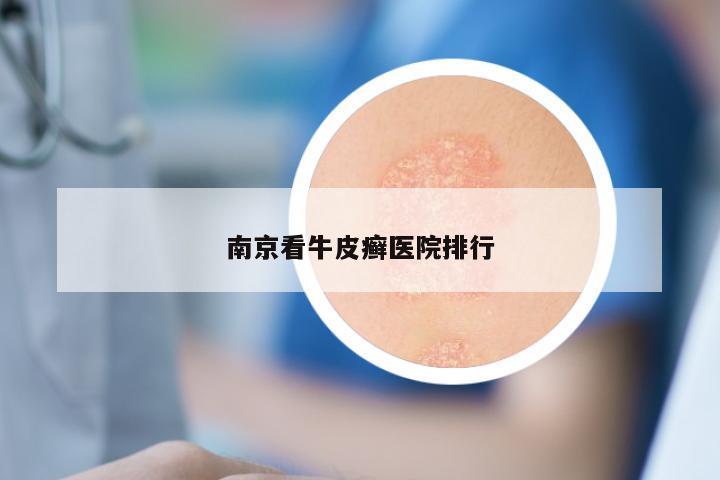 南京看牛皮癣医院排行