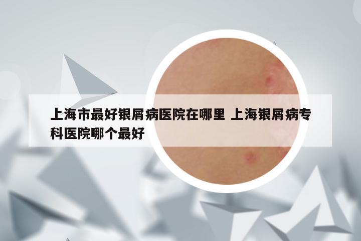 上海市最好银屑病医院在哪里 上海银屑病专科医院哪个最好