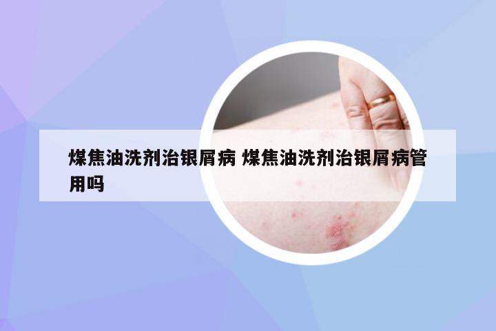 煤焦油洗剂治银屑病 煤焦油洗剂治银屑病管用吗