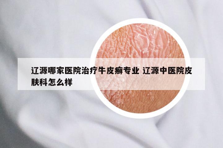 辽源哪家医院治疗牛皮癣专业 辽源中医院皮肤科怎么样