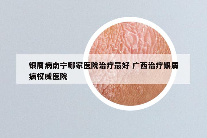 银屑病南宁哪家医院治疗最好 广西治疗银屑病权威医院