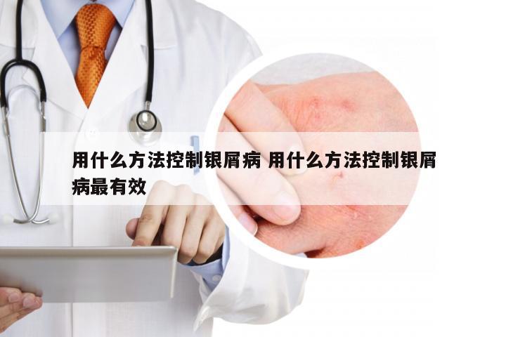 用什么方法控制银屑病 用什么方法控制银屑病最有效