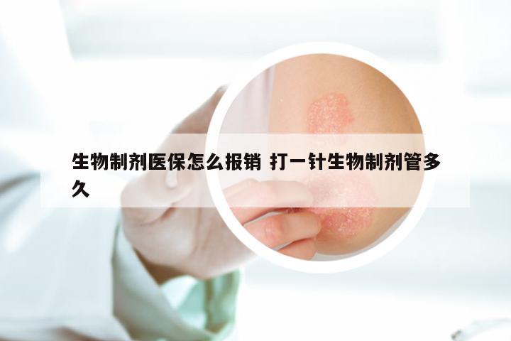 生物制剂医保怎么报销 打一针生物制剂管多久