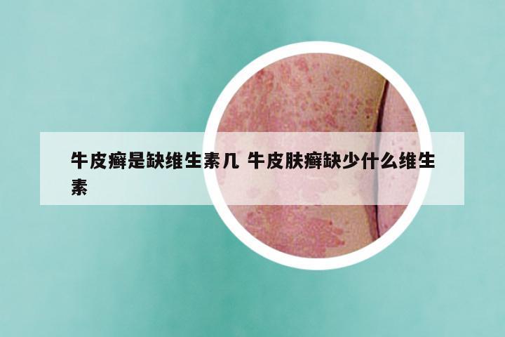 牛皮癣是缺维生素几 牛皮肤癣缺少什么维生素