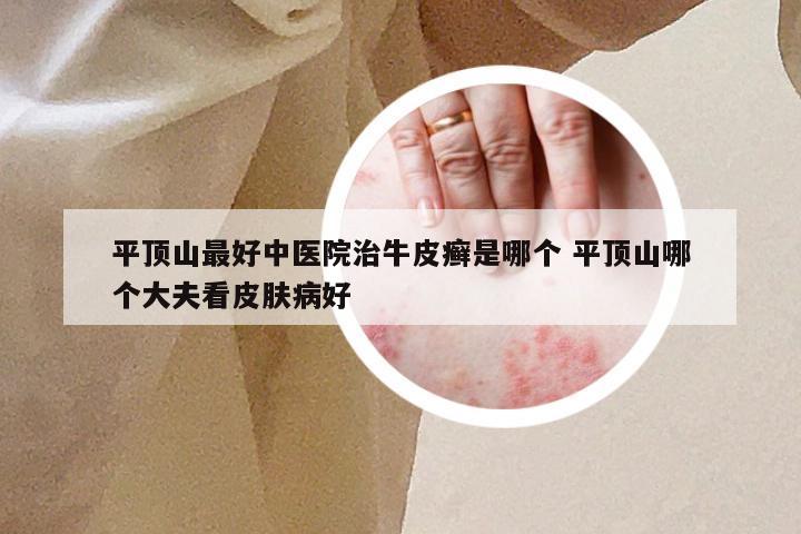 平顶山最好中医院治牛皮癣是哪个 平顶山哪个大夫看皮肤病好