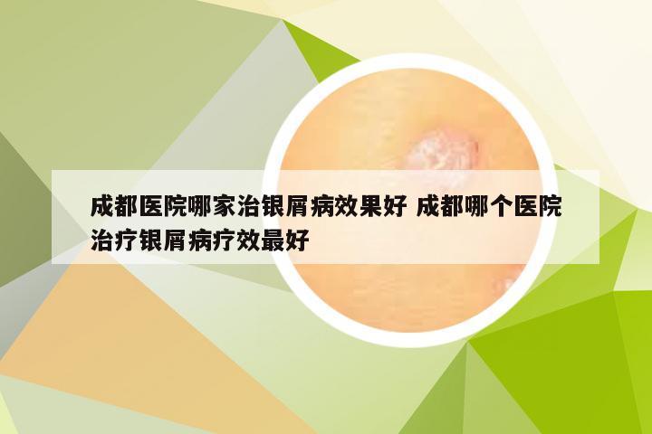 成都医院哪家治银屑病效果好 成都哪个医院治疗银屑病疗效最好