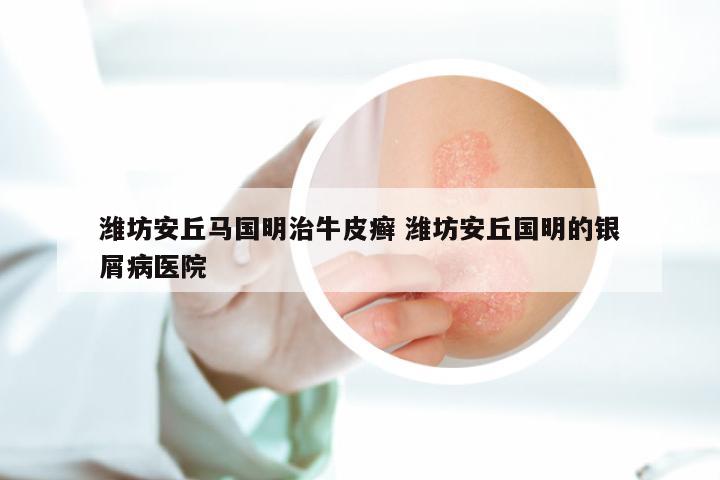 潍坊安丘马国明治牛皮癣 潍坊安丘国明的银屑病医院