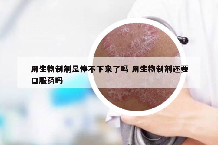 用生物制剂是停不下来了吗 用生物制剂还要口服药吗