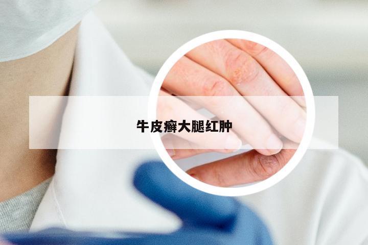 牛皮癣大腿红肿