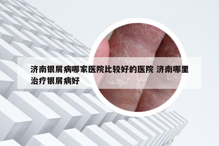济南银屑病哪家医院比较好的医院 济南哪里治疗银屑病好