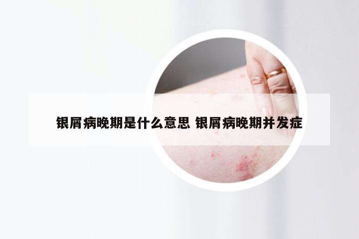 银屑病晚期是什么意思 银屑病晚期并发症