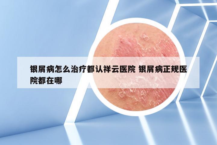 银屑病怎么治疗都认祥云医院 银屑病正规医院都在哪