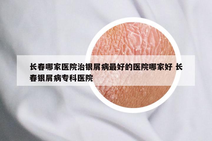长春哪家医院治银屑病最好的医院哪家好 长春银屑病专科医院