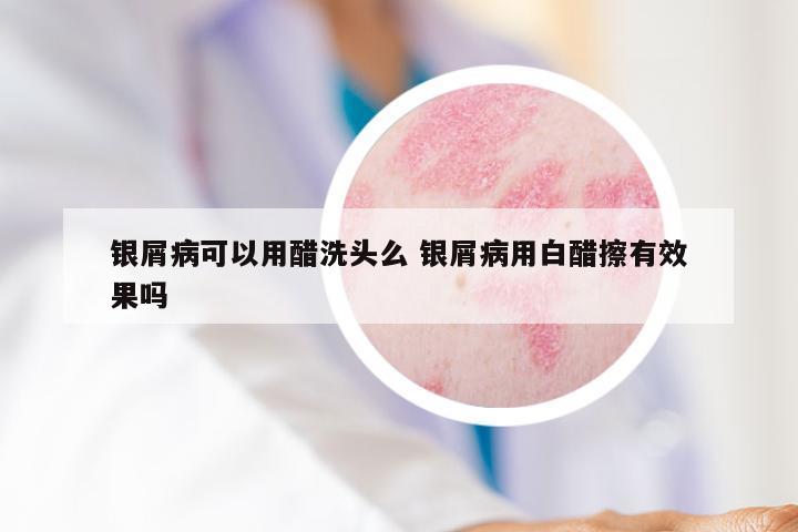 银屑病可以用醋洗头么 银屑病用白醋擦有效果吗