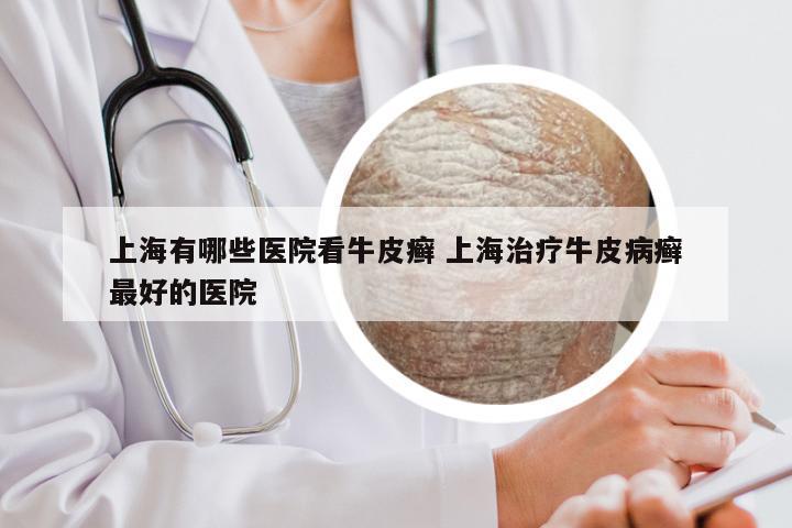 上海有哪些医院看牛皮癣 上海治疗牛皮病癣最好的医院