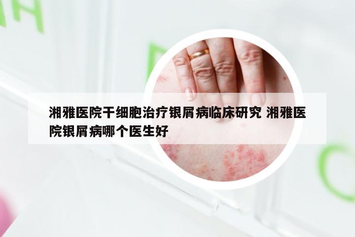 湘雅医院干细胞治疗银屑病临床研究 湘雅医院银屑病哪个医生好